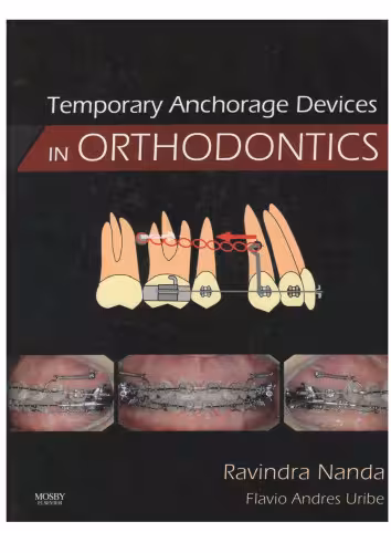 خرید و دانلود نسخه کامل کتاب Temporary Anchorage Devices in Orthodontics