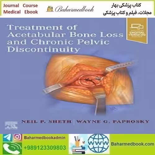 Treatment of Acetabular Bone Loss and Chronic Pelvic