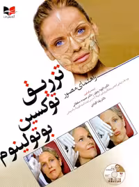 راهنمای مصور تزریق توکسین بوتولینوم رمزی آبادیس طب