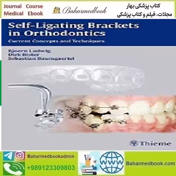 Self ligating Brackets in Orthodontics Current Concepts and Tec