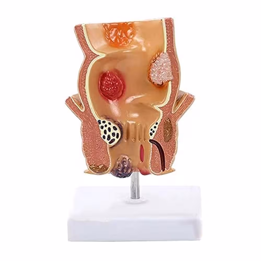 مولاژ رکتوم