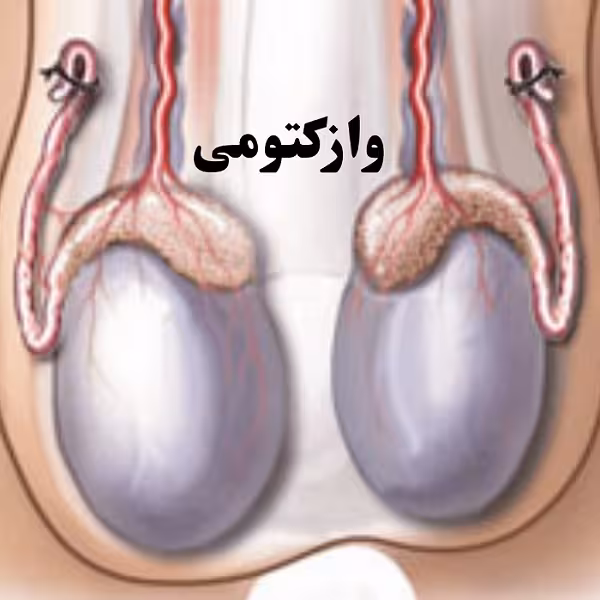 دانلود پاورپوینت کاندوم یا وازکتومی