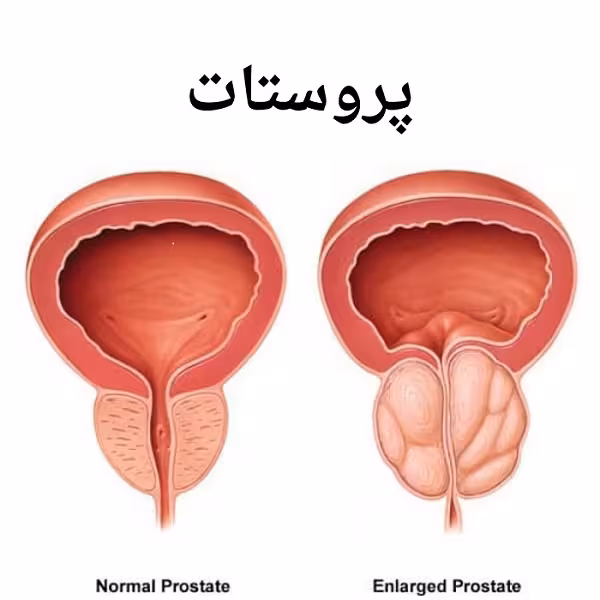 دانلود پاورپوینت بررسی پروستات