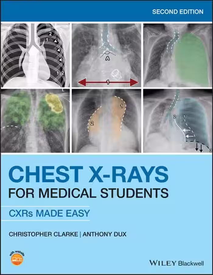 خرید و دانلود نسخه کامل کتاب Chest X-Rays for Medical Students: CXRs Made Easy