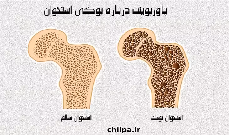پاورپوینت درباره پوکی استخوان - چیلپا