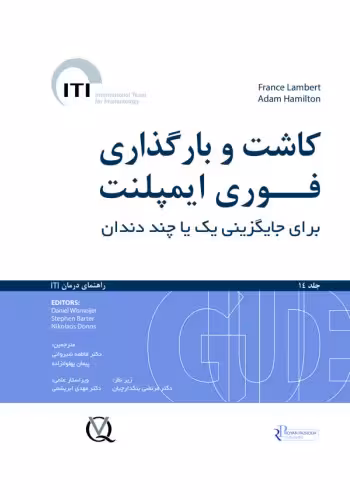 کاشت و بارگذاری فوری ایمپلنت برای جایگزینی یک یا چند دندان جلد 14
