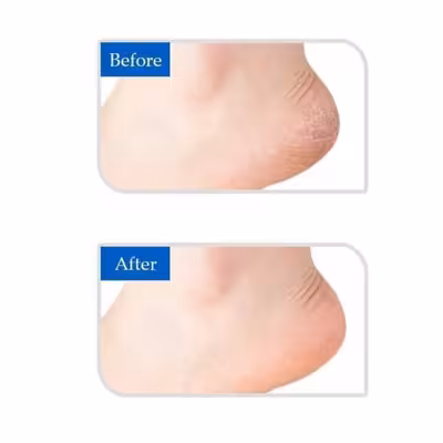 محافظ پاشنه دکتر فوت مدل Af01 بسته 2 عددی به همراه کفی طبی خار پاشنه کد 01 بسته 2 عددی