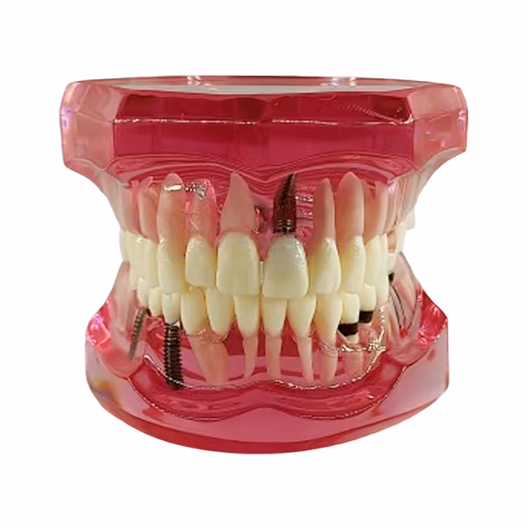 ماکت ایمپلنت صورتی