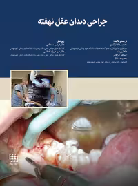 جراحی دندان عقل نهفته شایان نمودار
