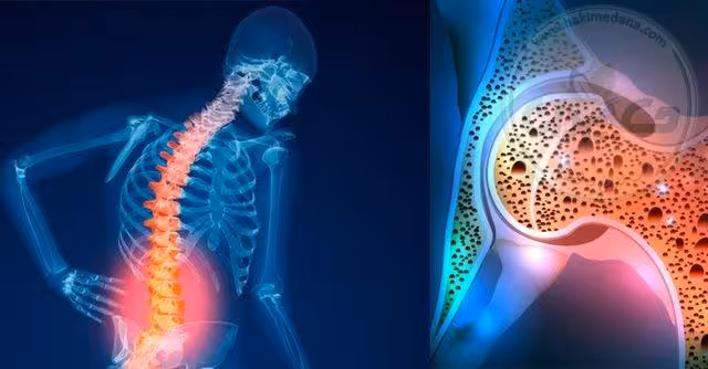 پک پوکی استخوان