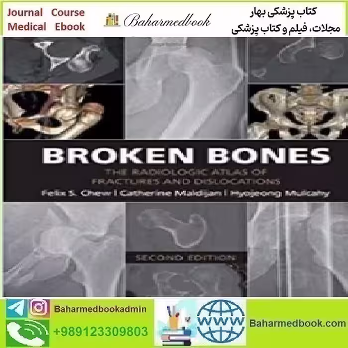 Broken Bones The Radiologic Atlas of Fractures and Disloc