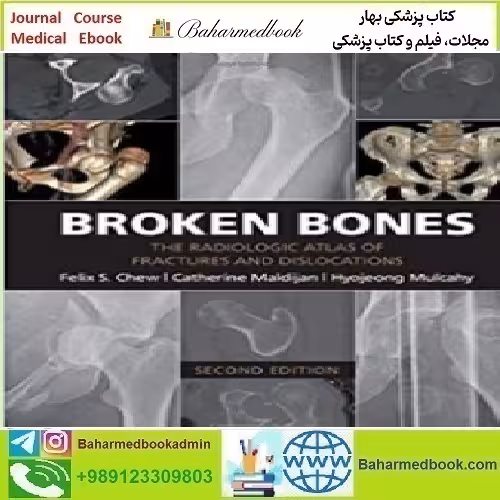 Broken Bones The Radiologic Atlas of Fractures and Disloc