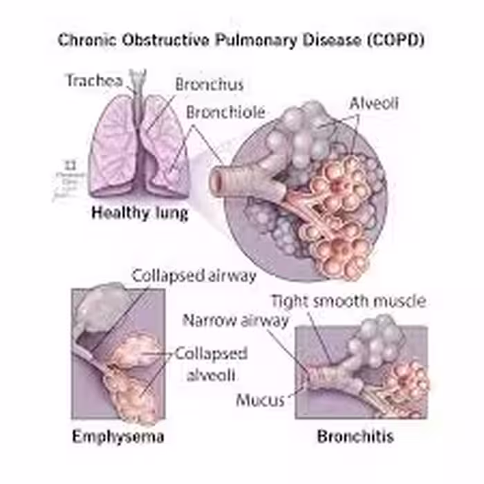 دانلود فایل پاورپوینت مبحث COPD درس داخلی پزشکی