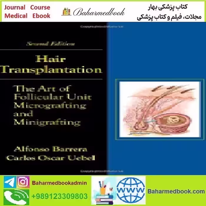 Hair Transplantation TRUE PDF price 1€ - کتاب پزشکی بهار