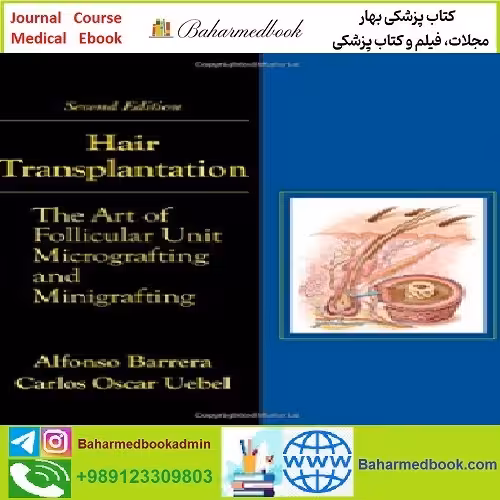 Hair Transplantation TRUE PDF price 1€ - کتاب پزشکی بهار