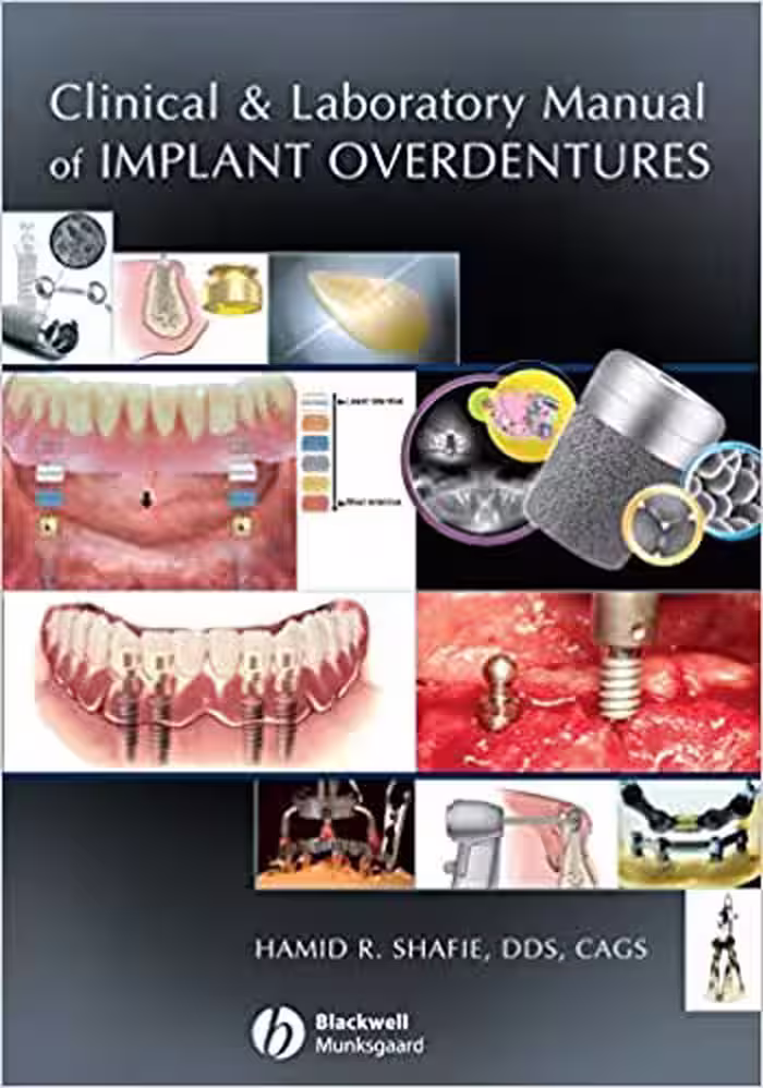 󾕇 دانلود کتاب Clinical And Laboratory Manual Of Implant Overdentures, 2007 - دانلود کتاب های دانشگاهی