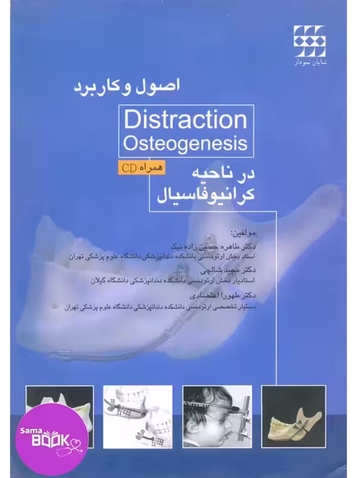 اصول و کاربرد Distraction Osteogenesis در ناحیه کرانیوفاسیال همراه با CD