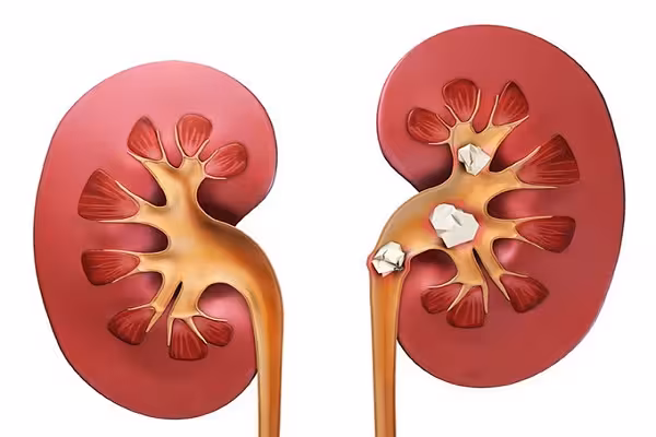 پاورپوینت درمان بیماری های کلیه