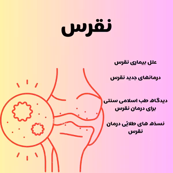پاورپوینت درمان نقرس