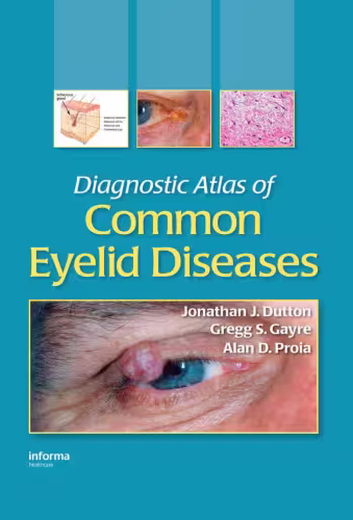 خرید و دانلود نسخه کامل کتاب Diagnostic Atlas of Common Eyelid Diseases
