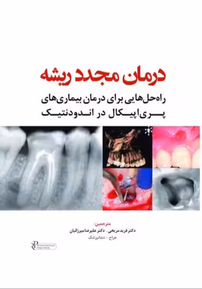 درمان مجدد ریشه راه حل هایی برای درمان بیماری های پری اپیکال در اندودنتیک