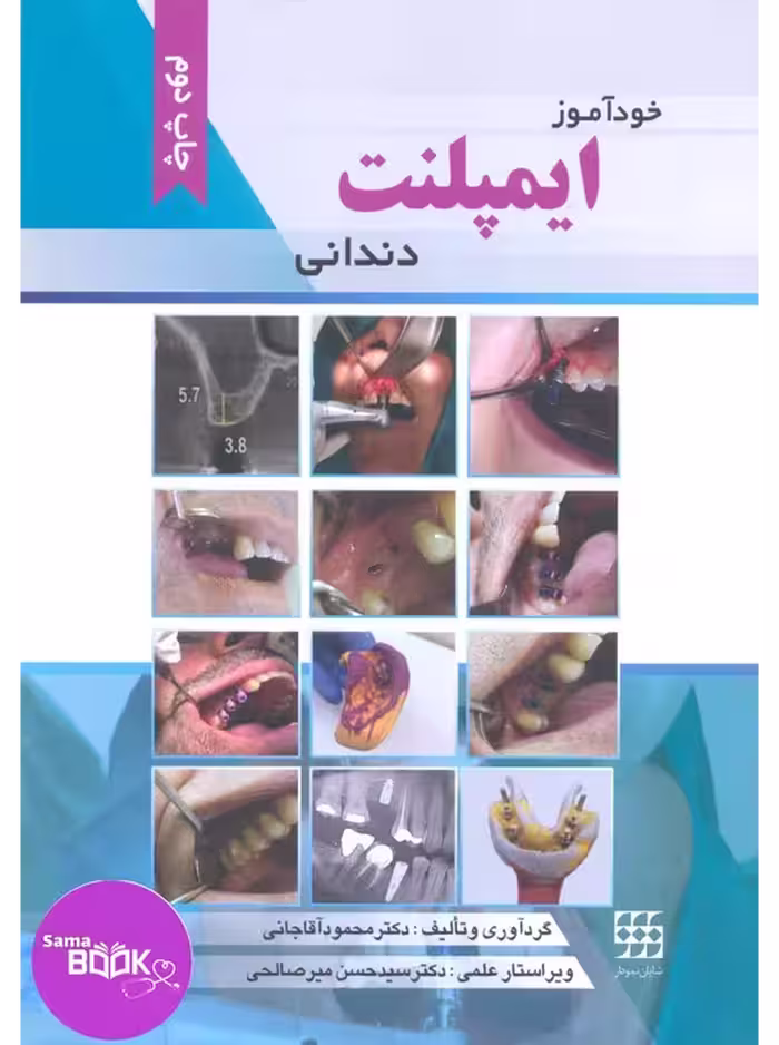 خودآموز ایمپلنت دندانی