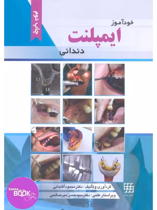 خودآموز ایمپلنت دندانی