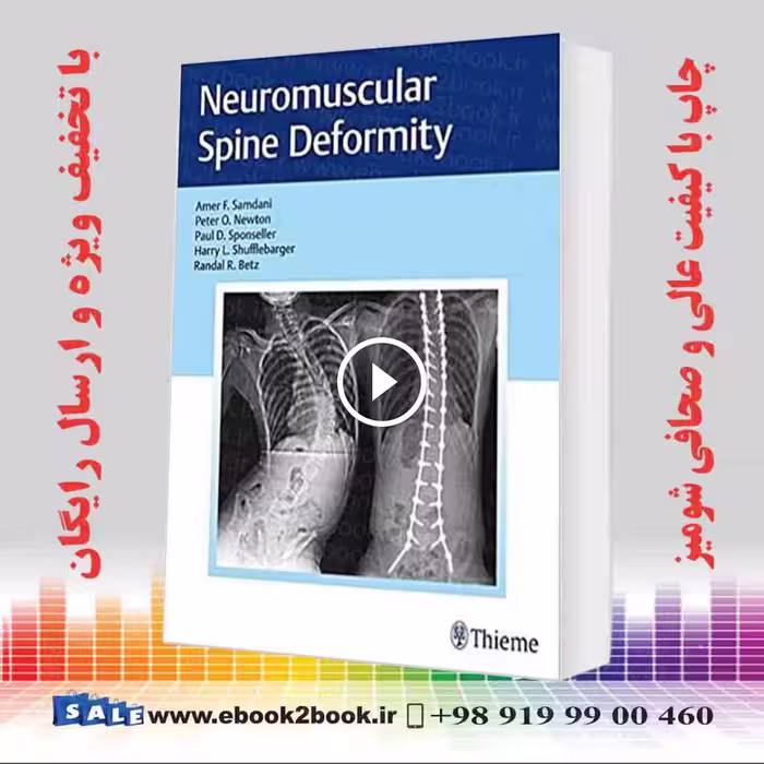 Neuromuscular Spine Deformity