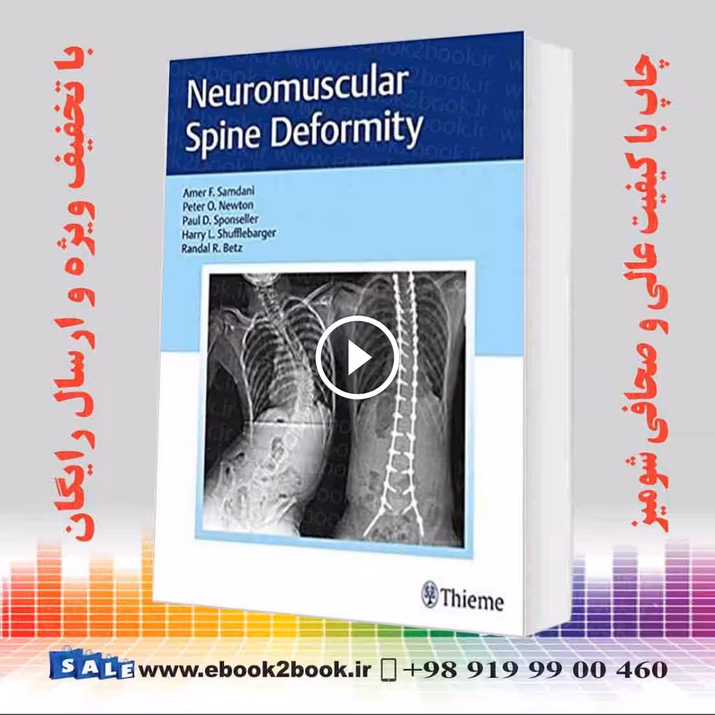 Neuromuscular Spine Deformity