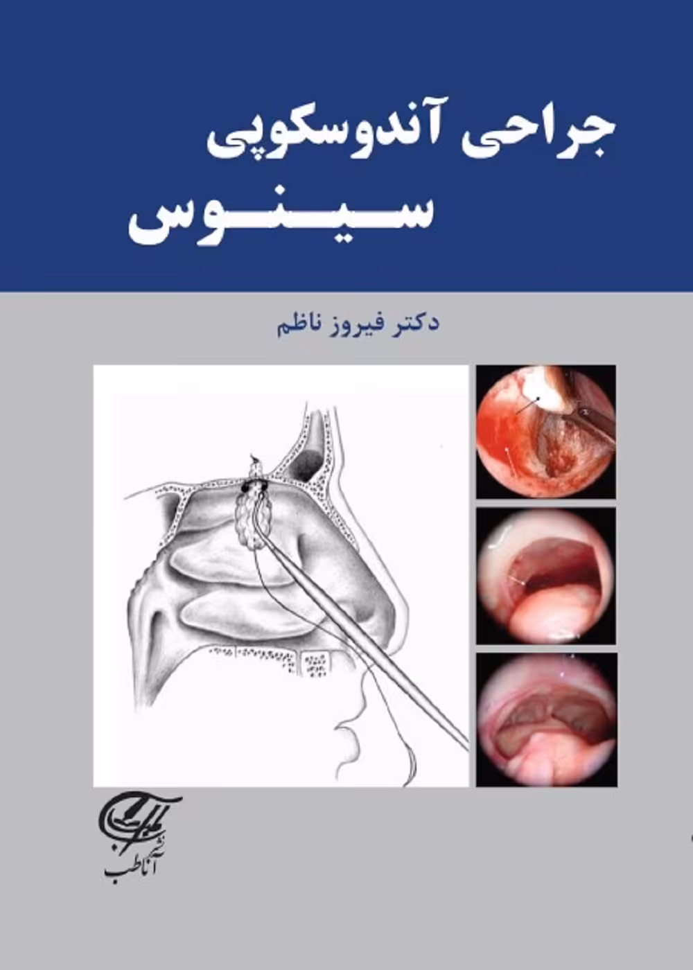 جراحی آندوسکوپی سینوس