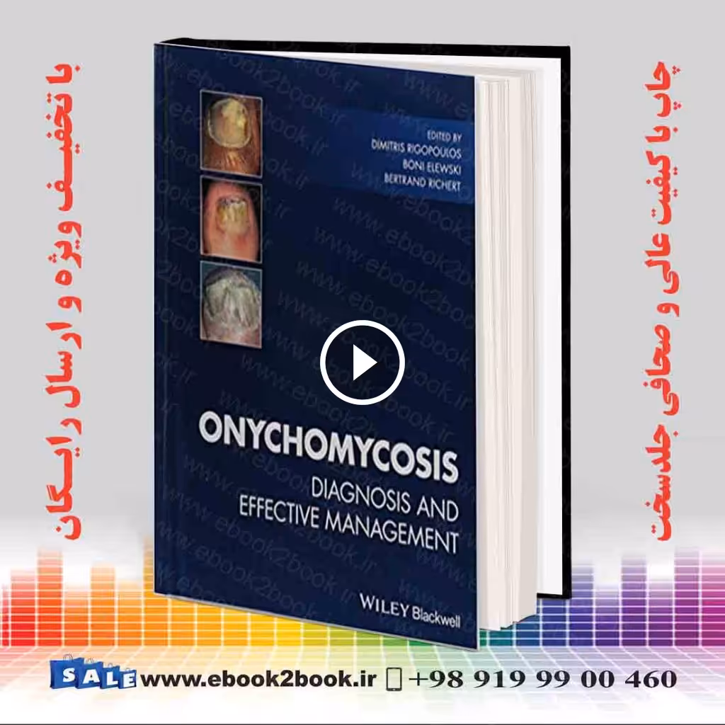 Onychomycosis: Diagnosis and Effective Management
