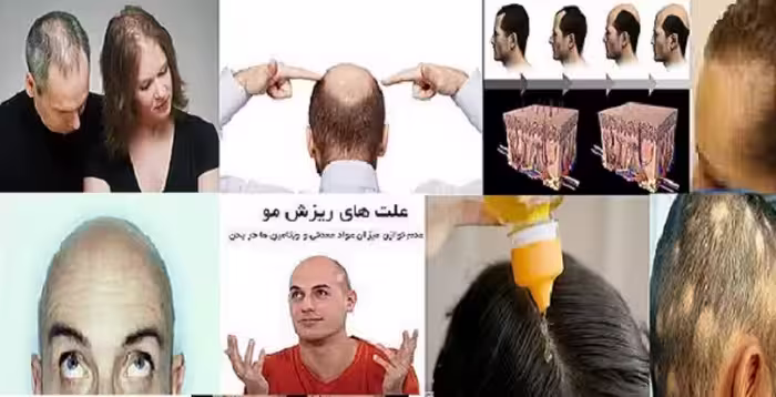 بروشور معرفی و آموزشی محلول رویش موی دکتر نوروزیان  فرمول جدید