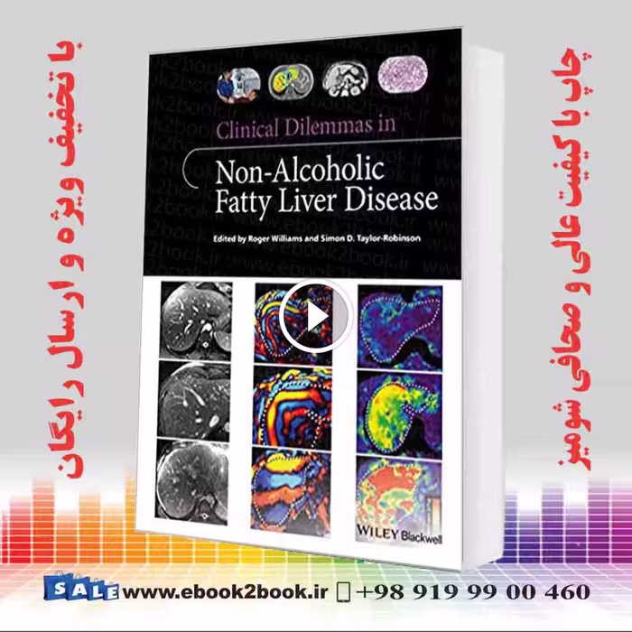 Clinical Dilemmas in Non-Alcoholic Fatty Liver Disease