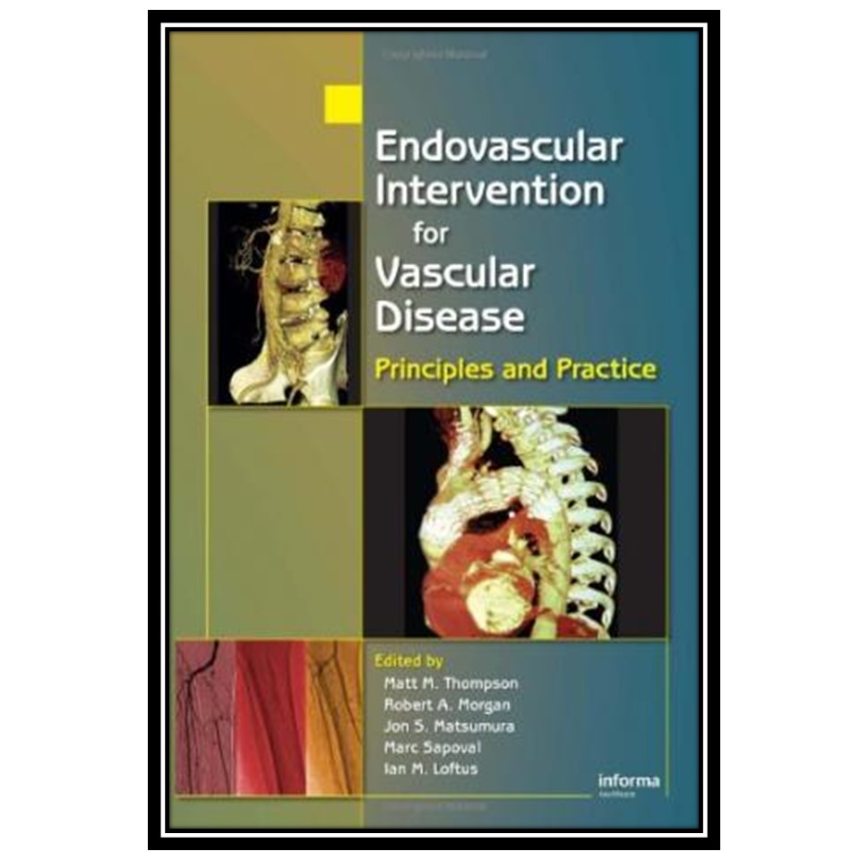 کتاب Endovascular Intervention for Vascular Disease اثر جمعی از نویسندگان انتشارات مؤلفین طلایی