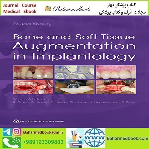 Bone and Soft Tissue Augmentation in Implantology 2021 TRUE