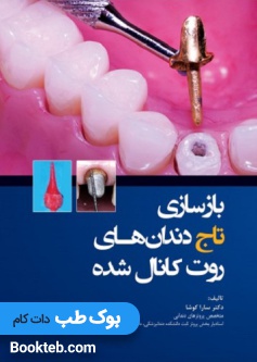 بازسازی تاج دندان های روت کانال شده