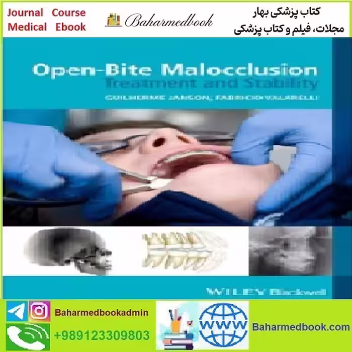 Open Bite Malocclusion TRUE PDF price 1€ - کتاب پزشکی بهار