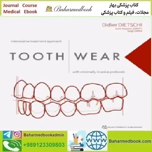 Tooth Wear Interceptive Treatment Approach With Minimally Inva