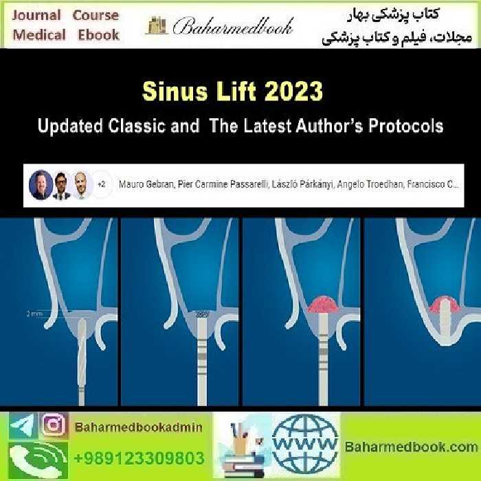 Sinus Lift 2023 Updated Classic and the Latest Author’s Protocols