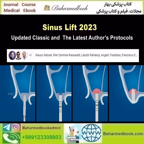 Sinus Lift 2023 Updated Classic and the Latest Author’s Protocols