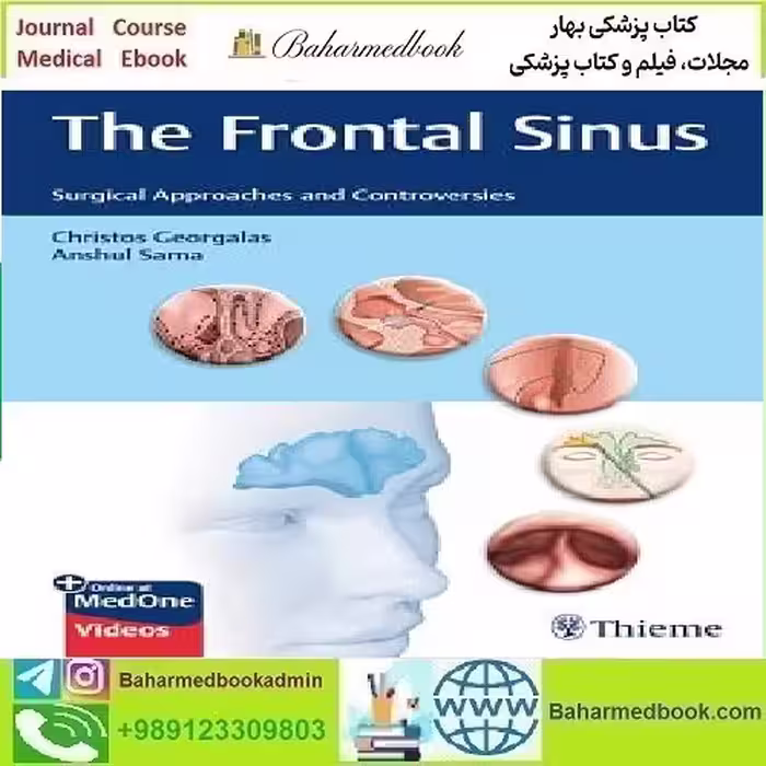 The Frontal Sinus Surgical Approaches and Controversies 2022