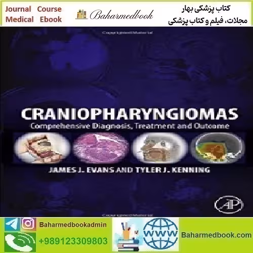Craniopharyngiomas Comprehensive Diagnosis Treatment an