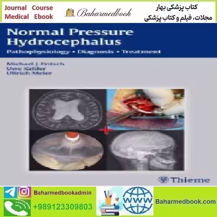 NPH Normal Pressure Hydrocephalus Pathophysiology Diagnosis