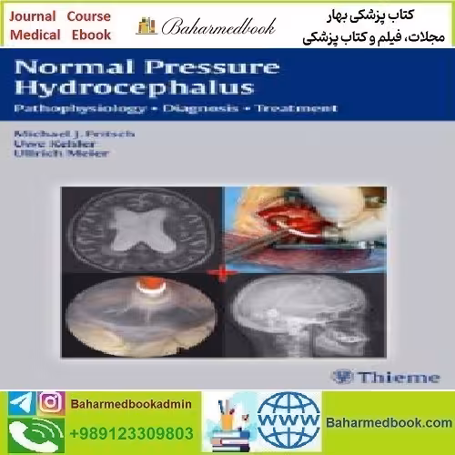NPH Normal Pressure Hydrocephalus Pathophysiology Diagnosis