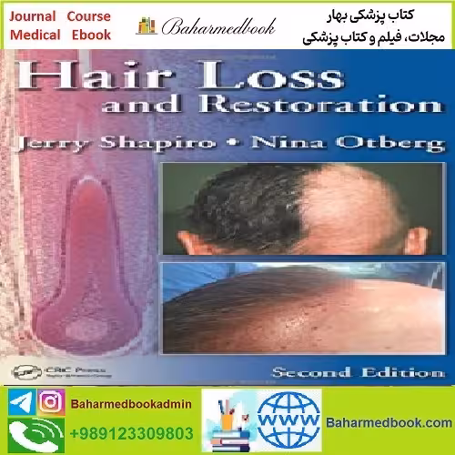 Hair Loss and Restoration TRUE PDF price 1€ - کتاب پزشکی بهار