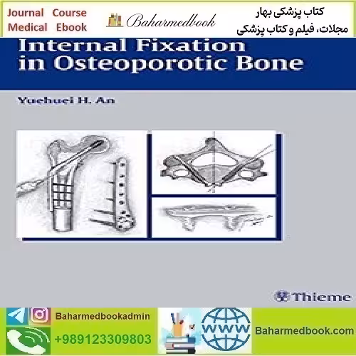 Internal Fixation in Osteoporotic Bone TRUE PDF price
