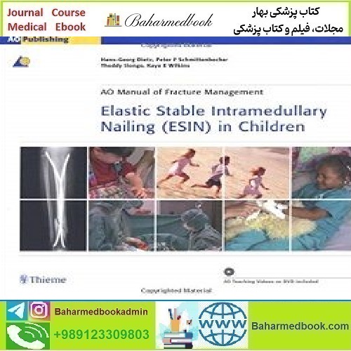 Elastic Stable Intramedullary Nailing (ESIN) in Children TRUE PDF