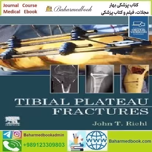 Tibial Plateau Fractures TRUE PDF price 2€ - کتاب پزشکی بهار