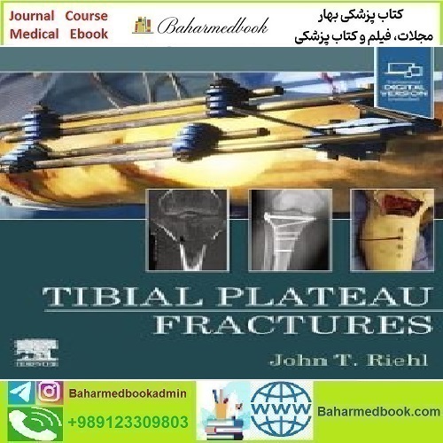 Tibial Plateau Fractures TRUE PDF price 2€ - کتاب پزشکی بهار
