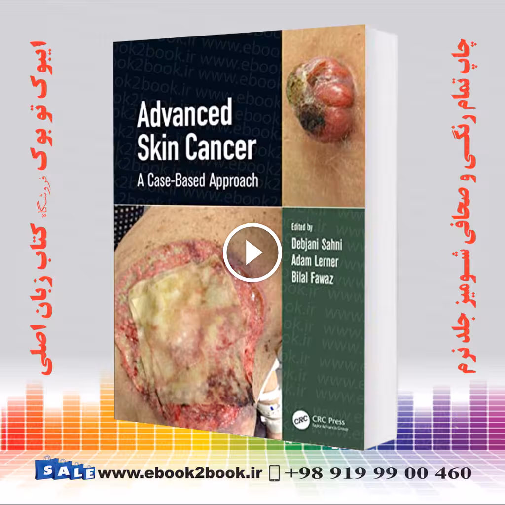 Advanced Skin Cancer: A Case-Based Approach